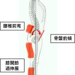 腰痛前弯