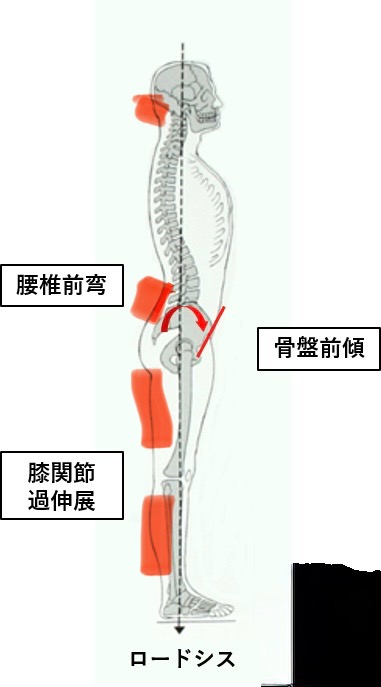 腰痛前弯
