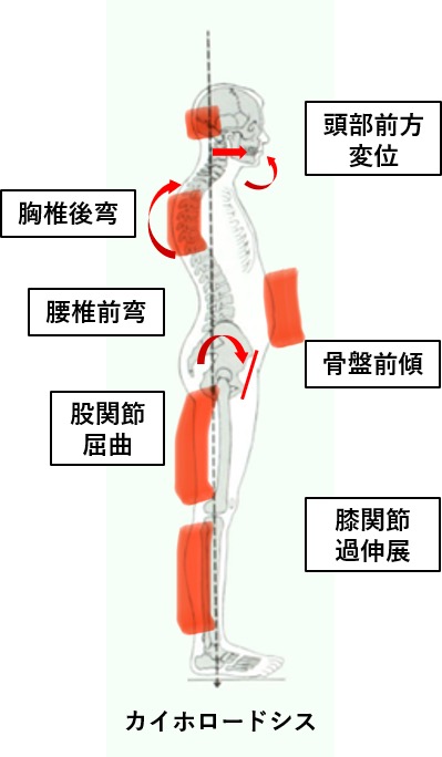 後弯